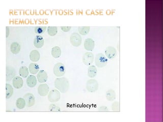 RETICULOCYTOSIS IN CASE OF
HEMOLYSIS
 