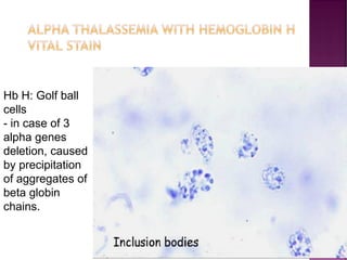 ALPHA THALASSEMIA WITH HEMOGLOBIN H
VITAL STAIN
Hb H: Golf ball
cells
- in case of 3
alpha genes
deletion, caused
by precipitation
of aggregates of
beta globin
chains.
 