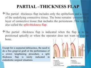 PARTIAL –THICKNESS FLAP
The partial –thickness flap includes only the epithelium and a layer
of the underlying connective tissue. The bone remains covered by a
layer of connective tissue that includes the periosteum .This type is
also called the split-thickness flap.
The partial –thickness flap is indicated when the flap is to be
positioned apically or when the operator does not want to expose
bone.
Except for a suspected dehiscence, the need to
do a free gingival graft or the performance of
a crown lengthening procedure, a split
thickness flap is rarely indicated in
endodontic surgical situations
 