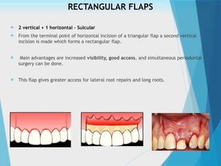 RECTANGULAR FLAPS
 2 vertical + 1 horizontal – Sulcular
 From the terminal point of horizontal incision of a triangular flap a second vertical
incision is made which forms a rectangular flap.
 Main advantages are increased visibility, good access, and simultaneous periodontal
surgery can be done.
 This flap gives greater access for lateral root repairs and long roots.
 
