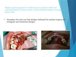 Palatal surgical approach is limited only to posterior teeth and
contraindicated in anterior teeth, which should be ideally accessed from
buccal side.
 Nowadays the only two flap designs indicated for palatal surgery are
triangular and horizontal designs.
 