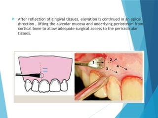  After reflection of gingival tissues, elevation is continued in an apical
direction , lifting the alveolar mucosa and underlying periosteum from
cortical bone to allow adequate surgical access to the periradicular
tissues.
 