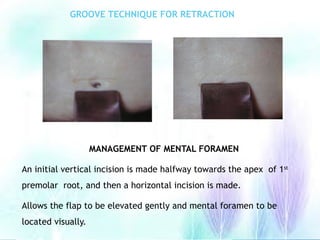 GROOVE TECHNIQUE FOR RETRACTION
MANAGEMENT OF MENTAL FORAMEN
An initial vertical incision is made halfway towards the apex of 1st
premolar root, and then a horizontal incision is made.
Allows the flap to be elevated gently and mental foramen to be
located visually.
 