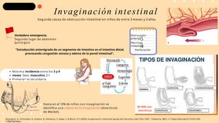 “Introducción anterógrada de un segmento de intestino en el intestino distal,
provocando congestión venosa y edema de la pared intestinal”.
Ostrucción
arterial.
Necrosis
intestinal.
Perforación
.
Verdadera emergencia.
Segundo lugar de abdomen
quirúrgico
Invaginación intestinal
Segunda causa de obstrucción intestinal en niños de entre 3 meses y 3 años.
Máxima incidencia entre los 5 y 9
meses. Sexo: masculino 2:1.
Primaria+ vs secundaria.
80-90% son
ileocólicas.
Hasta en el 12% de niños con invaginación se
identifica una cabeza de la invaginación (divertículo
de Meckel).
Rossignol, G., Schneider, G., Dubois, R., Hameury, F., Gelas, T., & Mure, P.-Y. (2023). Invaginación intestinal aguda del lactante y del niño. EMC - Pediatría, 58(1), 1–7. https://doi.org/10.1016/s1245-
1789(23)47446-x
 