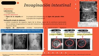 Invaginación intestinal
Diagnóstico:
Laboratorios:
Inespecíficos.
Ecografía abdominal:
Signo de la rosquilla en la proyección transversal y el signo del pseudo riñón
en la proyección longitudinal.
Radiografía simple de abdomen:
Lesión ocupante de espacio, signo de la dinaa, signo de la semiluna (protrusión
de la cabeza invaginante en el asa del instestino distal), ausencia de aire y heces en el
intestino distal.
Signos de obstrucción (niveles hidroaéreos) o perforacipon digestiva
(neumoperitoneo).
Rossignol, G., Schneider, G., Dubois, R., Hameury, F., Gelas, T., & Mure, P.-Y. (2023). Invaginación intestinal aguda del lactante y del niño. EMC - Pediatría, 58(1), 1–7. https://doi.org/10.1016/s1245-
1789(23)47446-x
 