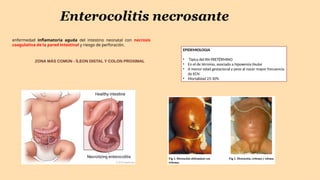Enterocolitis necrosante
enfermedad inflamatoria aguda del intestino neonatal con necrosis
coagulativa de la pared intestinal y riesgo de perforación.
ZONA MÁS COMÚN - ÍLEON DISTAL Y COLON PROXIMAL
EPIDEMIOLOGIA
• Típica del RN PRETÉRMINO
• En el de término, asociado a hipoxemia tisular
• A menor edad gestacional y peso al nacer mayor frecuencia
de ECN
• Mortalidad 25-30%
 