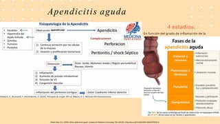 apendicular
Apendicitis aguda
4 estadios:
En función del grado de inflamación de la
apéndice.
 