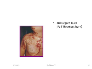 Normal Burn Pattern Skeleton Burn types how to manage based on severity | PDF