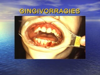 GINGIVORRAGIESGINGIVORRAGIES
 