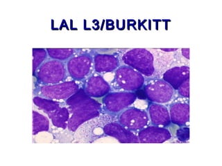 LAL L3/BURKITTLAL L3/BURKITT
 