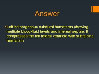 Answer
Left heterogenous subdural hematoma showing
multiple blood-fluid levels and internal septae. It
compresses the left lateral ventricle with subfalcine
herniation
 