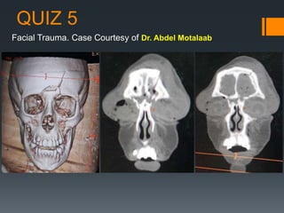 QUIZ 5
Facial Trauma. Case Courtesy of Dr. Abdel Motalaab
 