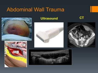 Abdominal Wall Trauma
Ultrasound CT
 