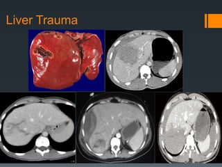 Liver Trauma
 