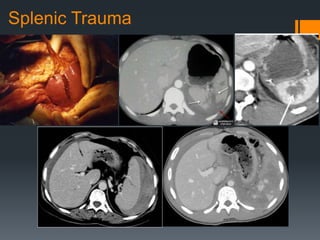 Splenic Trauma
 