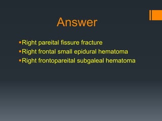 Answer
Right pareital fissure fracture
Right frontal small epidural hematoma
Right frontopareital subgaleal hematoma
 