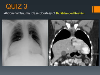 QUIZ 3
Abdominal Trauma. Case Courtesy of Dr. Mahmoud Ibrahim
 