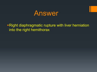 Answer
Right diaphragmatic rupture with liver herniation
into the right hemithorax
 