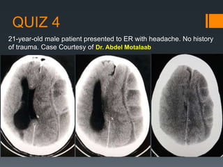 QUIZ 4
21-year-old male patient presented to ER with headache. No history
of trauma. Case Courtesy of Dr. Abdel Motalaab
 