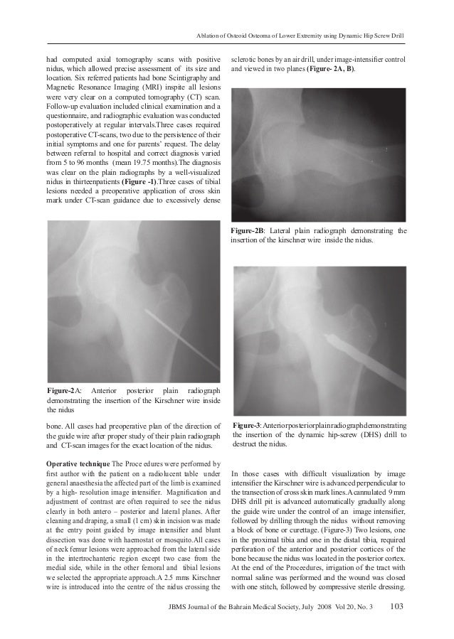 Ablation Of Osteoid Osteoma البروفيسور فريح ابوحسان استشاري جراحة