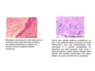 Metaplasia escamosa em cisto localizado na
cavidade nasal. Este cisto está recoberto
por epitélio estratificado e células com
formato ovóide e poligonal (epitélio
escamoso).
Vemos aqui células epiteliais anaplásicas, ou
seja, mais indiferenciadas (próximas da forma
embrionária). Uma das características mais
marcantes é a grande variabilidade de
tamanhos que elas possuem, bem como o
hipercromatismo nuclear (setas). Mitoses ditas
atípicas são também observadas com essas
células, as quais caracterizam as neoplasias.
 