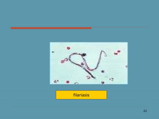22
filariasis
 