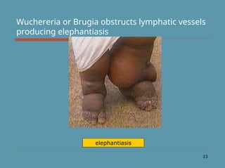 23
Wuchereria or Brugia obstructs lymphatic vessels
producing elephantiasis
elephantiasis
 