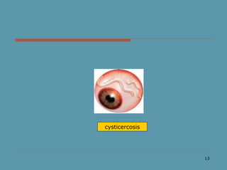 13
cysticercosis
 