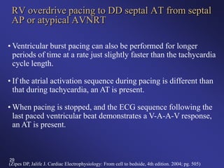 High Rv Pacing Atrial Tachycardia | PDF