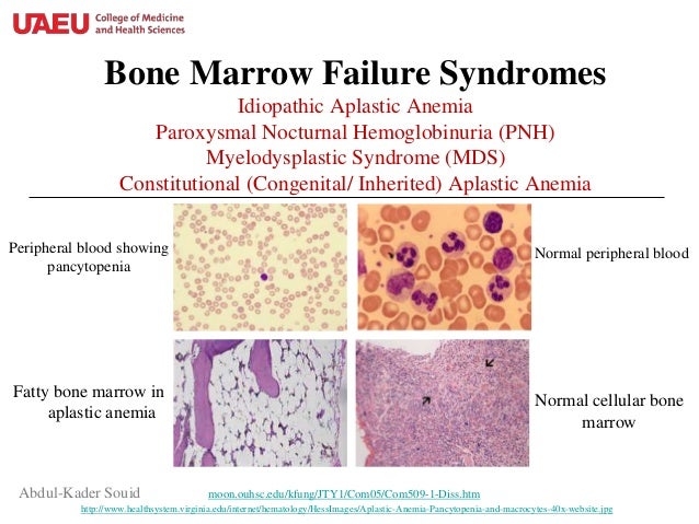 Bone marrow failure syndromes.ppt Bone marrow failure syndromes.ppt