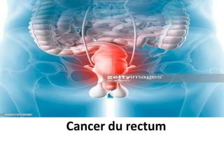 Cancer du rectum
Cancer du rectum
 