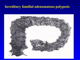 hereditary familial adenomatous polyposis 