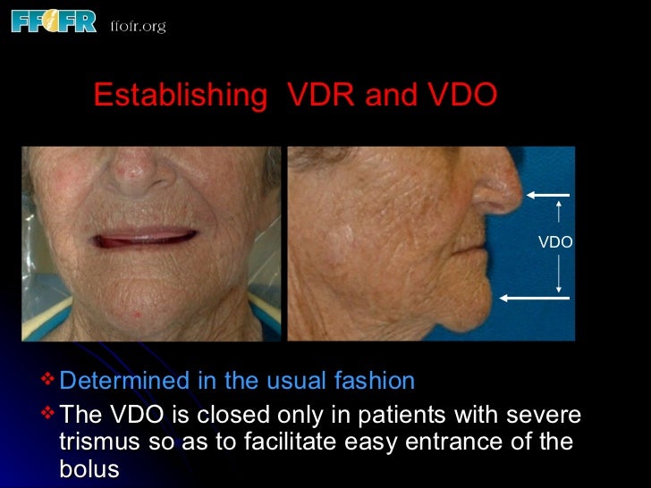 Complete Dentures for Irradiated Patients