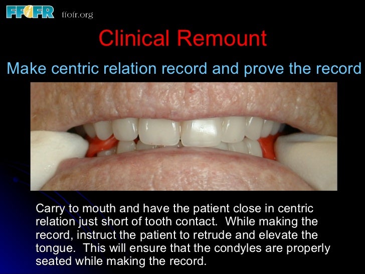 Complete Dentures for Irradiated Patients