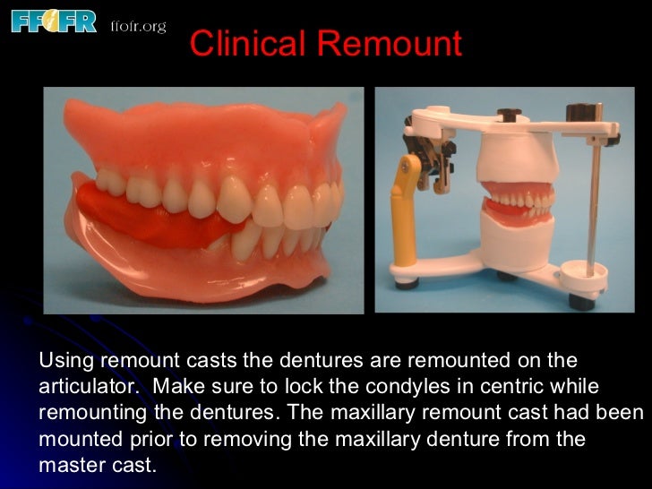 Complete Dentures for Irradiated Patients