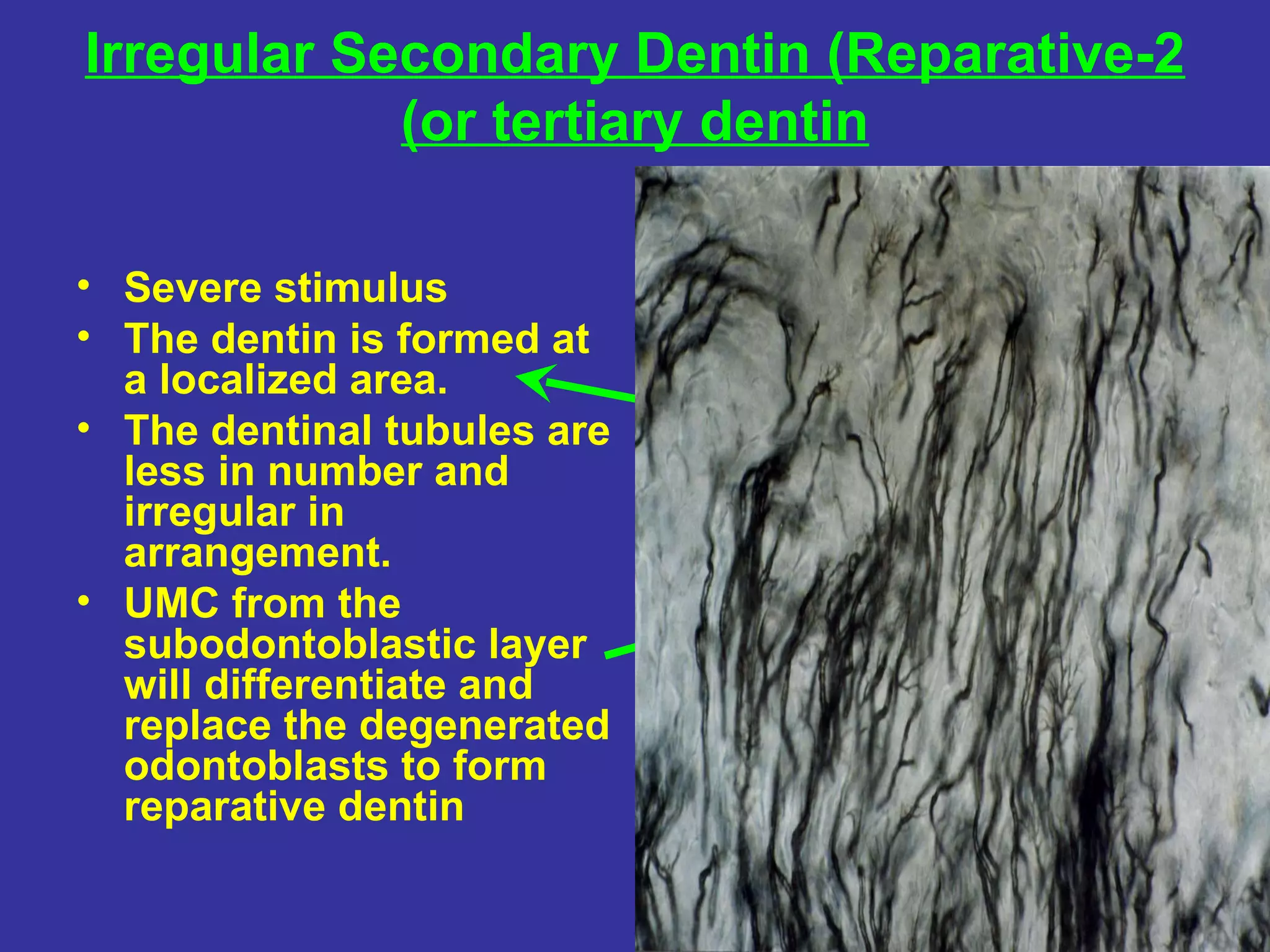 Irregular Secondary Dentin (Reparative-2
            (or tertiary dentin

• Severe stimulus
• The dentin is formed at
  a localized area.
• The dentinal tubules are
  less in number and
  irregular in               Irregular D T
  arrangement.
• UMC from the
  subodontoblastic layer
  will differentiate and
  replace the degenerated
  odontoblasts to form
  reparative dentin
 