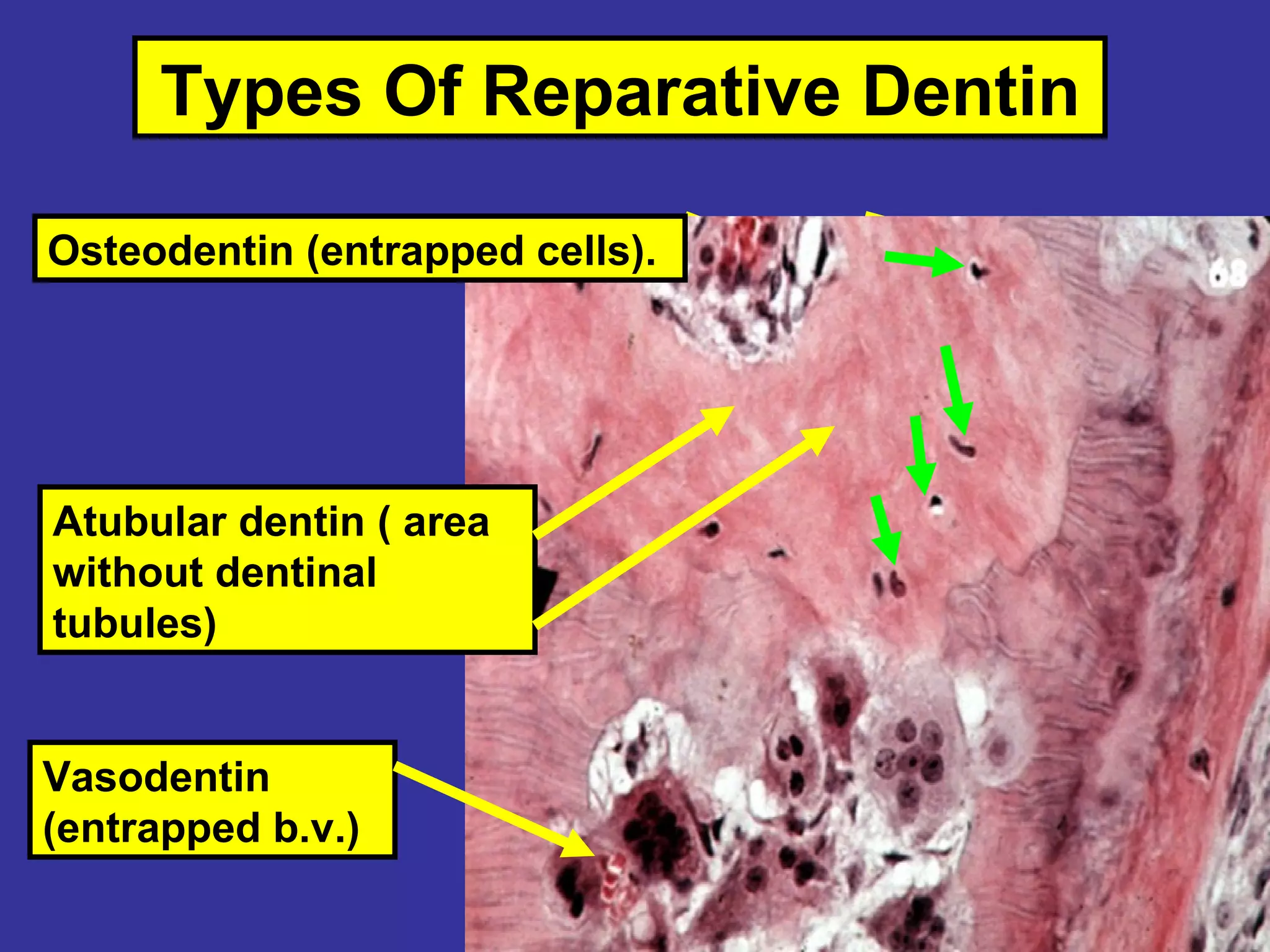 Types Of Reparative Dentin

Osteodentin (entrapped cells).




Atubular dentin ( area
without dentinal
tubules)


Vasodentin
(entrapped b.v.)
 