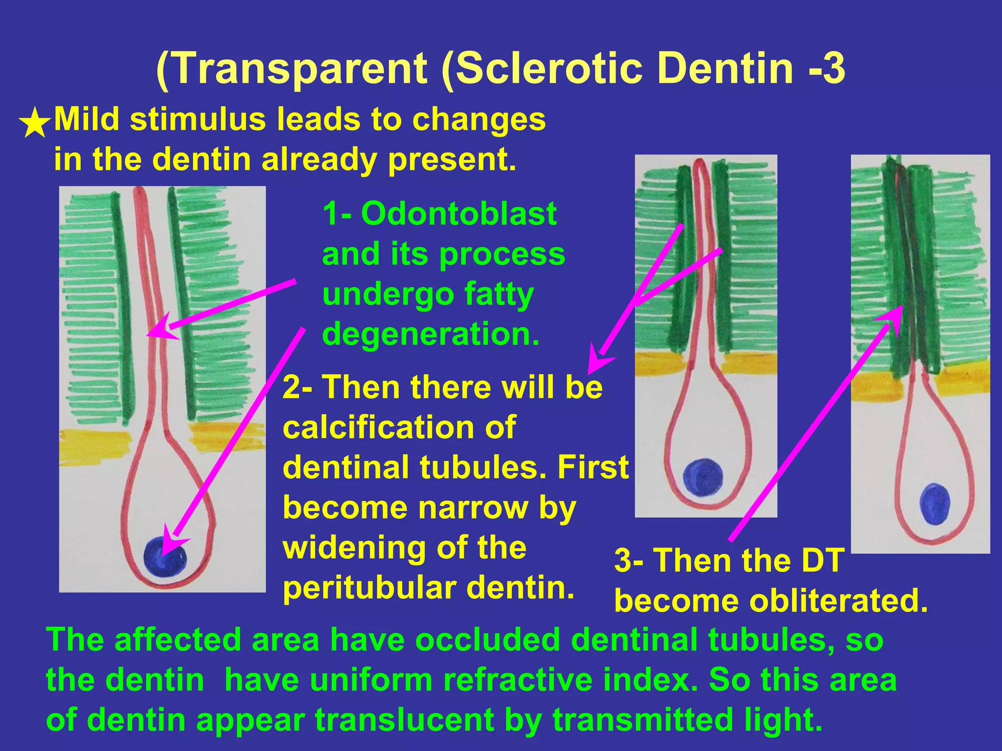 (Transparent (Sclerotic Dentin -3
Mild stimulus leads to changes
in the dentin already present.
                 1- Odontoblast
                 and its process
                 undergo fatty
                 degeneration.
              2- Then there will be
              calcification of
              dentinal tubules. First
              become narrow by
              widening of the       3- Then the DT
              peritubular dentin. become obliterated.
The affected area have occluded dentinal tubules, so
the dentin have uniform refractive index. So this area
of dentin appear translucent by transmitted light.
 