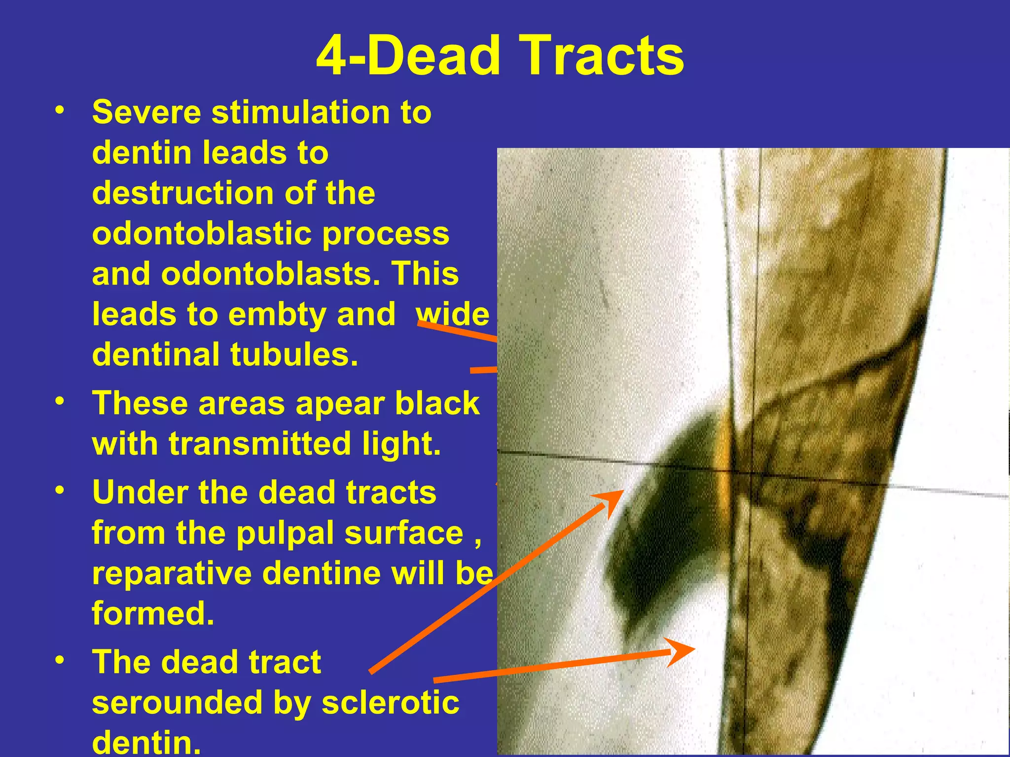 4-Dead Tracts
• Severe stimulation to
  dentin leads to
  destruction of the
  odontoblastic process
  and odontoblasts. This
  leads to embty and wide
  dentinal tubules.
• These areas apear black
  with transmitted light.
• Under the dead tracts
  from the pulpal surface ,
  reparative dentine will be
  formed.
• The dead tract
  serounded by sclerotic
  dentin.
 