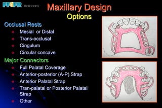 Maxillary Design
                              Options
Occlusal Rests
  v    Mesial or Distal
  v    Trans-occlusal
  v    Cingulum
  v    Circular concave
Major Connectors
  v    Full Palatal Coverage
  v    Anterior-posterior (A-P) Strap
  v    Anterior Palatal Strap
  v    Tran-palatal or Posterior Palatal
        Strap
  v    Other
 