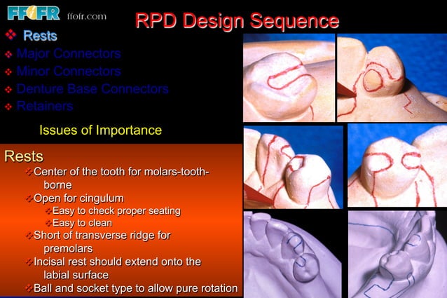 7.designing rpd's, planning sequence for rpd patients | PDF | Dental ...