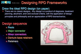 Designing RPD Frameworks
Draw the ideal RPD design (on paper)
v  There are no classic designs. Any design is a product of diagnosis, treatment
    planning, abutment, arch and occlusal criteria, with the application of design
    principles and philosophy and an appreciation of RPD biomechanics.


Design sequence
    v  Rests
    v  Major connector
    v  Minor connectors
    v  Denture base retainers
    v  Retainers
 