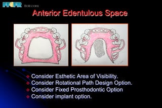 Anterior Edentulous Space




v  Consider Esthetic Area of Visibility.
v  Consider Rotational Path Design Option.
v  Consider Fixed Prosthodontic Option
v  Consider implant option.
 