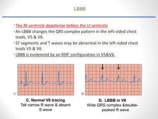 Peaked R Complex Comprehensive Assessment of Cardiovascular Dysrhythmias and Conduction ...
