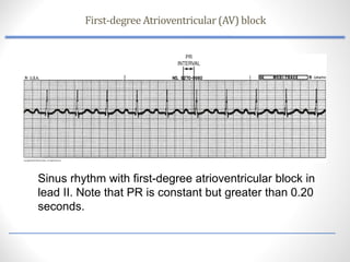 Comprehensive Assessment of Cardiovascular Dysrhythmias and Conduction ...