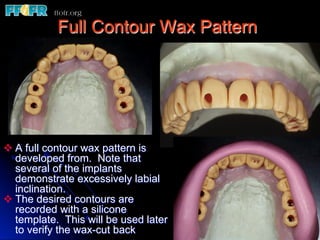 Edentulous Maxilla - Fixed Prostheses | PDF
