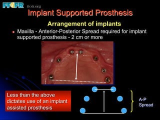 Edentulous Maxilla - Fixed Prostheses | PDF