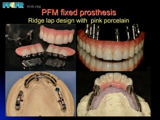 Edentulous Maxilla - Fixed Prostheses | PDF