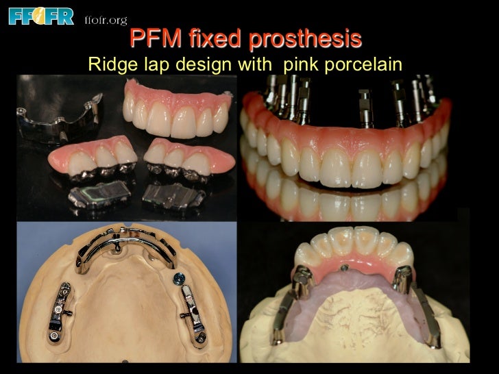 Edentulous Maxilla Fixed Prostheses