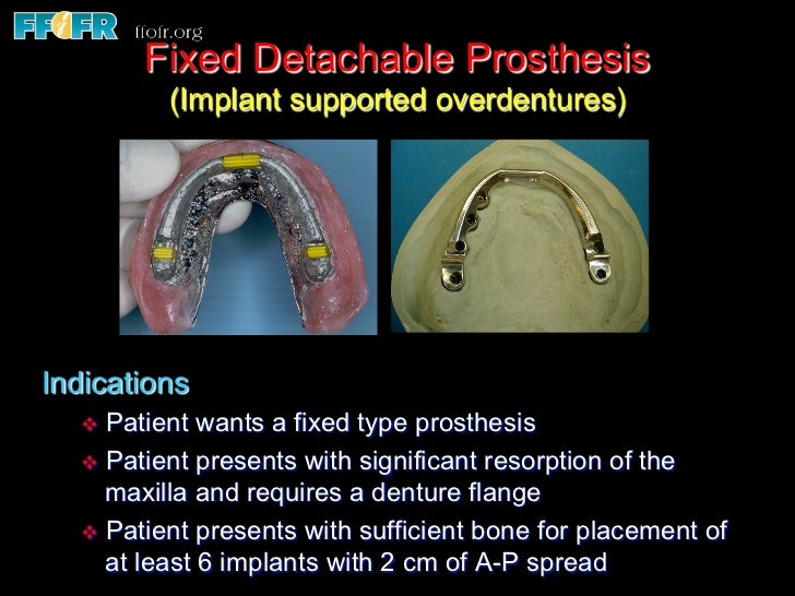 Edentulous Maxilla Fixed Prostheses